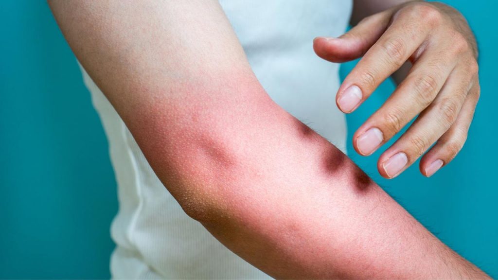 Close-up of an arm with visible redness as the person scratches an itchy area