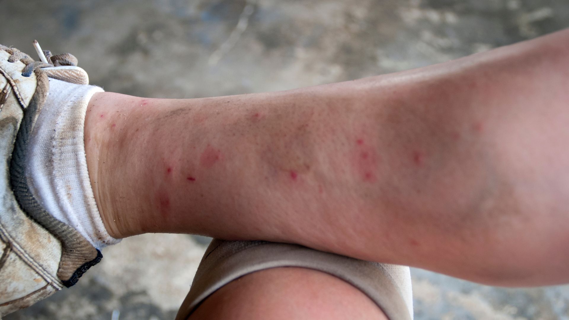 A close-up of a leg with redness and swelling, showing an itchy area from a bee sting