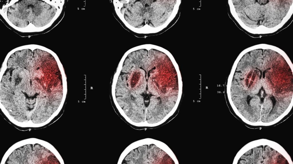 Brain Damage in a CT scan