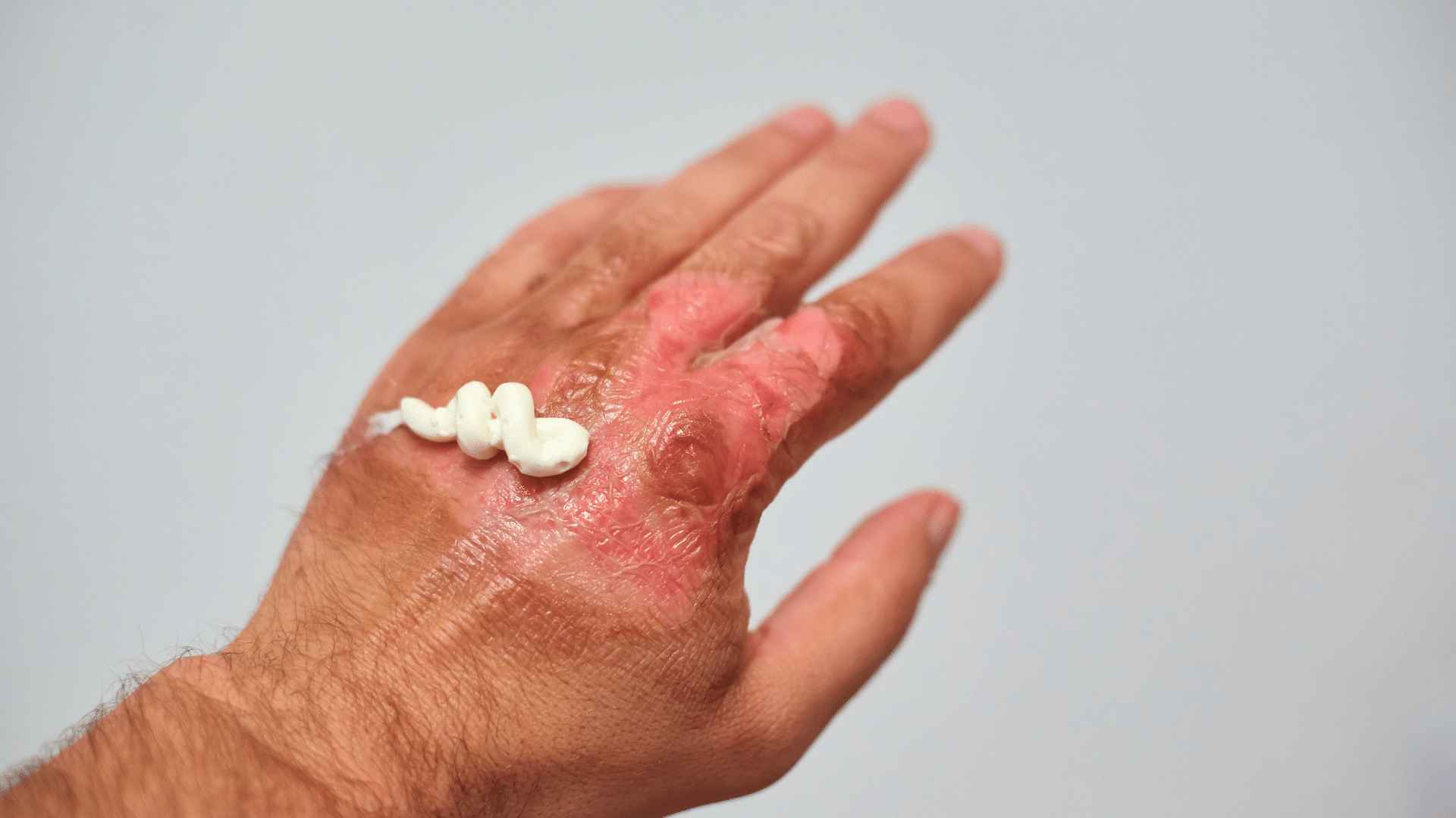 Ointment on Burn on Hand