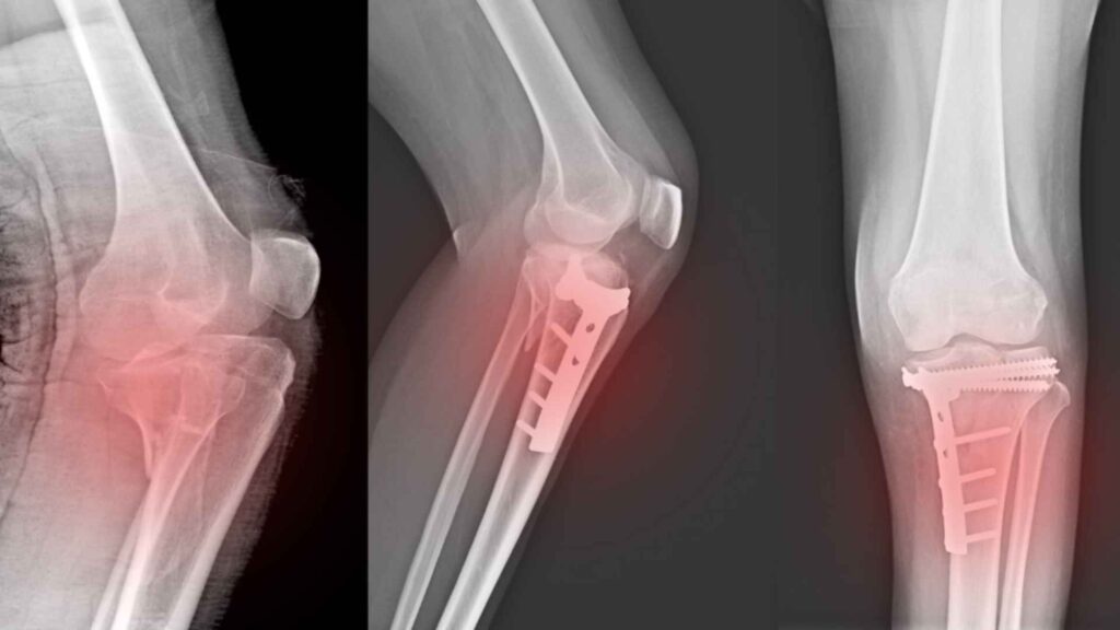 fractures in a x-ray