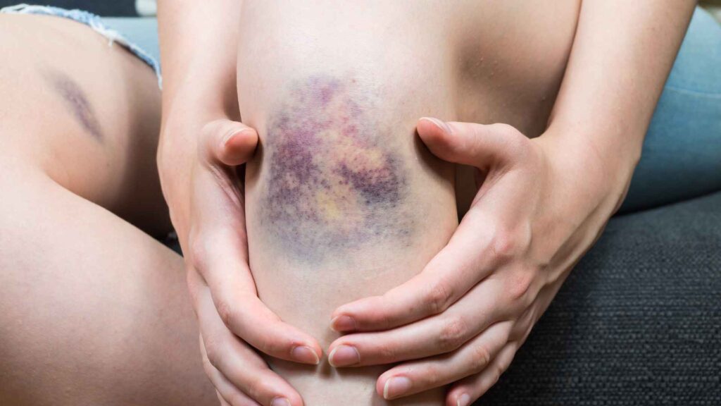 A person showing a bruise in her knee